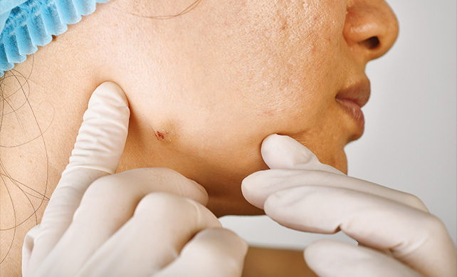 Acne Scarring 01