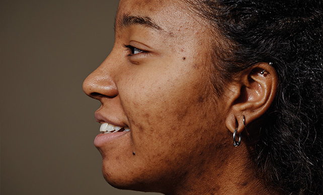 Acne Scarring 02