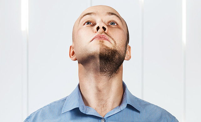 Beard Transplant 03