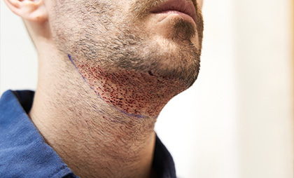 Beard Transplant 06