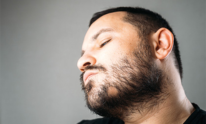 Beard Transplant 07