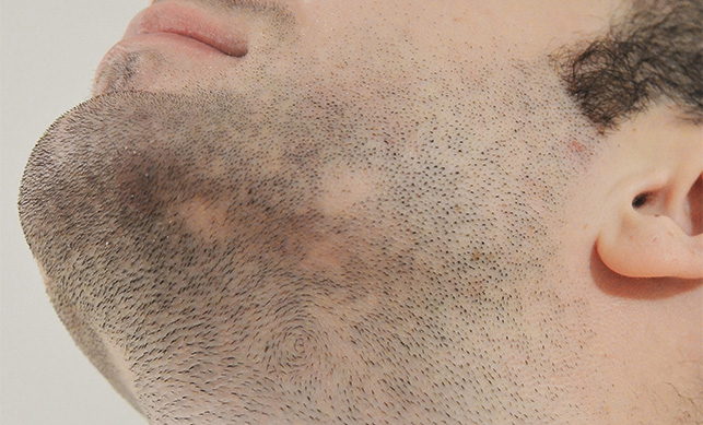 Beard Transplant 09
