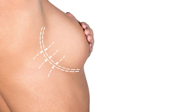 Breast Lift 02 1