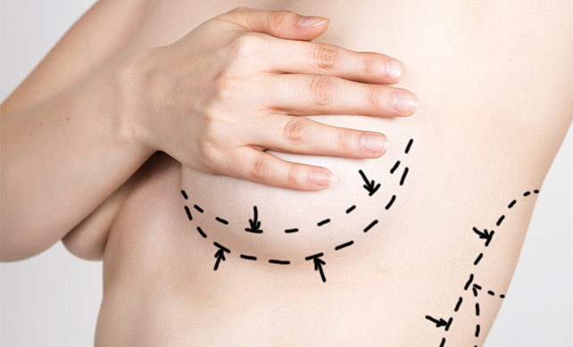 Breast Lift-03
