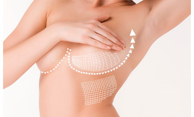 Breast Lift 04