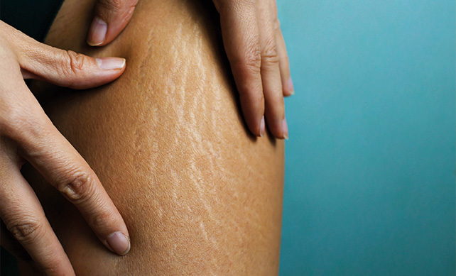 Cellulite 01