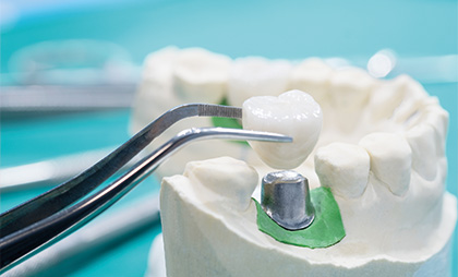 Dental Crowns 5