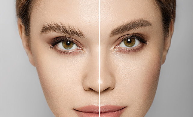 Eyebrow Transplant 02