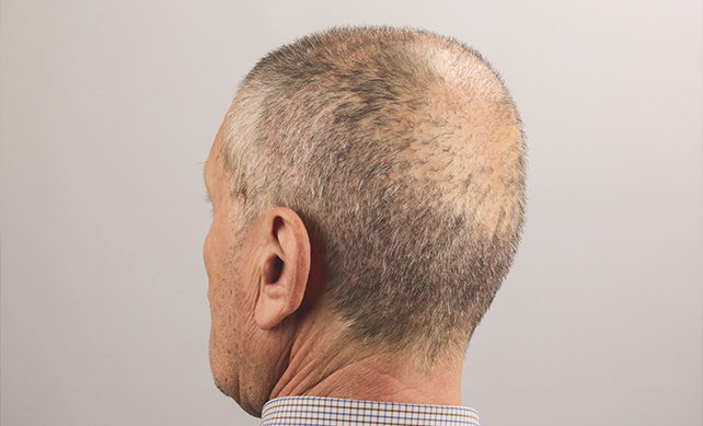 Fue Hair Transplant 02 1