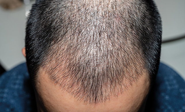 Fue Hair Transplant 03
