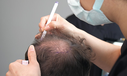 Fue Hair Transplant 05 1