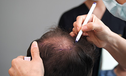 Fue Hair Transplant 06