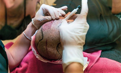 Fue Hair Transplant 07 1