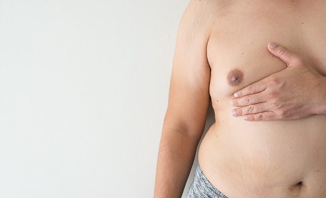 Gynecomastia 02 1