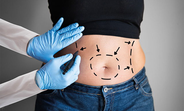 Liposuction-01