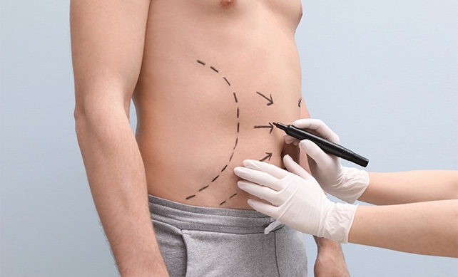 Liposuction 03 1