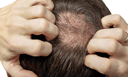 Mesotherapy For Hair 06