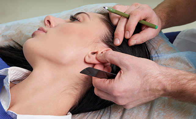 Otoplasty 01