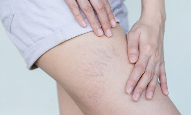 Spider Veins 01