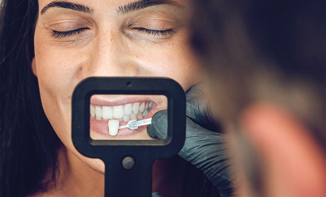Teeth Veneers 02