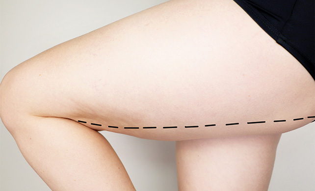 Thigh Lift 04