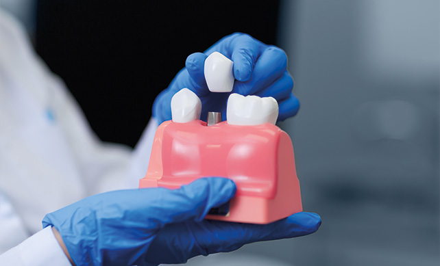Tooth Implant 01