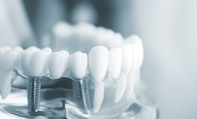 Tooth Implant 02