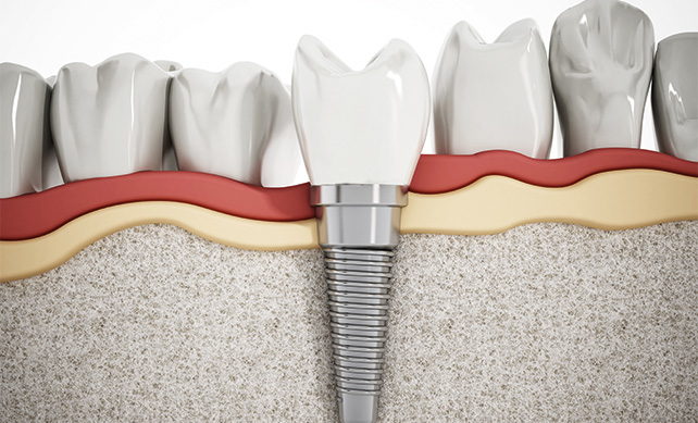 Tooth Implant 04