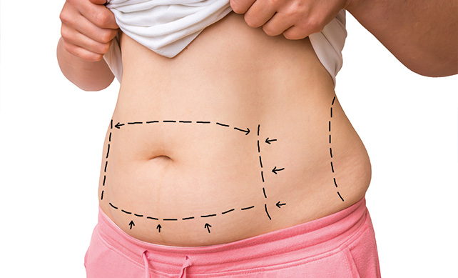 Tummy Tuck-02