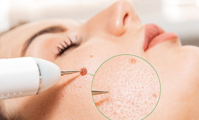Wart Treatment 01