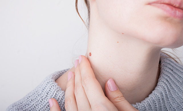 Wart Treatment 03