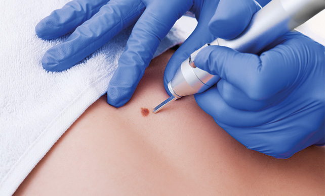 Wart Treatment 04
