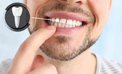 Zirconium Implants 06 1