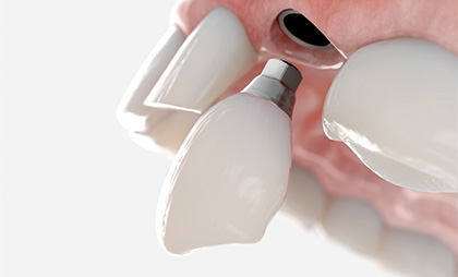 Zirconium Implants 07 1