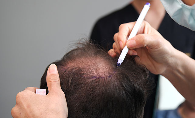 DHI Hair Transplant 31