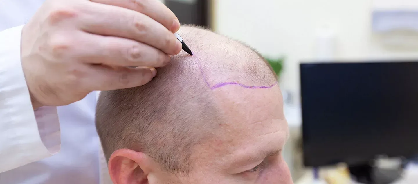 Trapianto di capelli Turchia vs Regno Unito