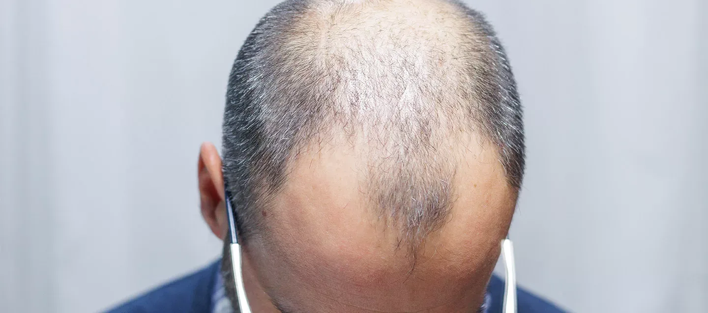 Hair Transplant Turkey VS US