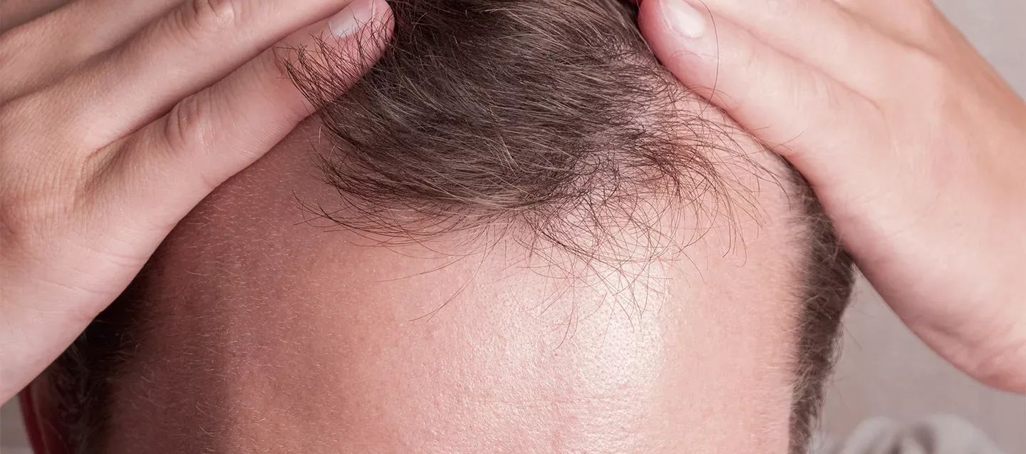 Trapianto Di Capelli Turchia VS Francia