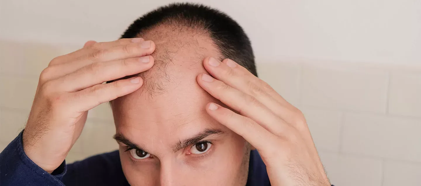 Trapianto di capelli Germania vs Turchia