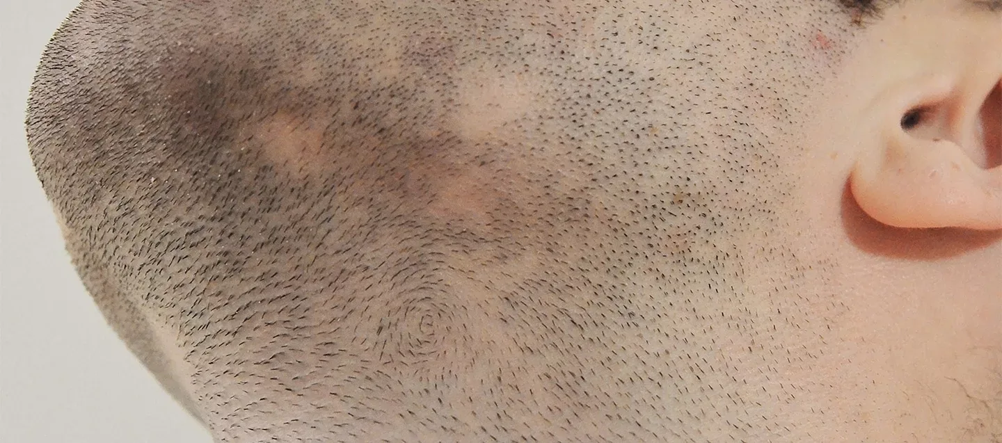 Beard and Mustache Transplantation