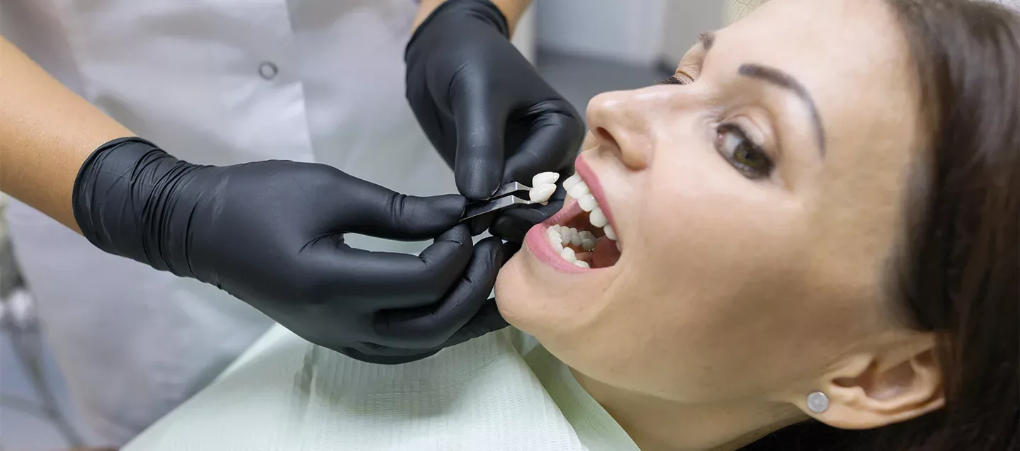 Porcelain Crowns