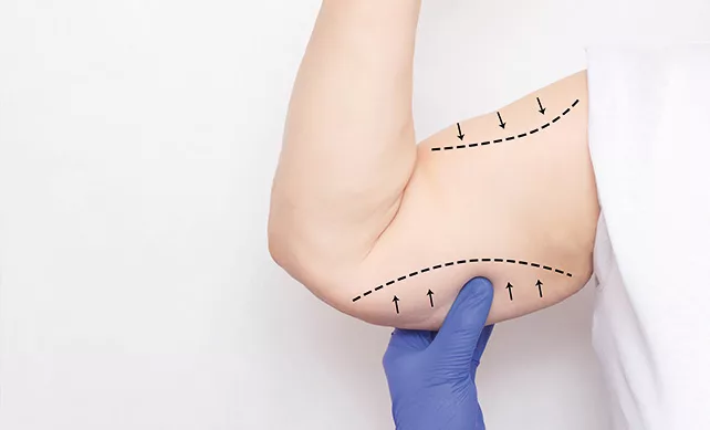 Arm Lift Surgery (Brachioplasty) 01