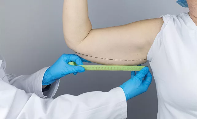 Arm Lift Surgery (Brachioplasty) 03
