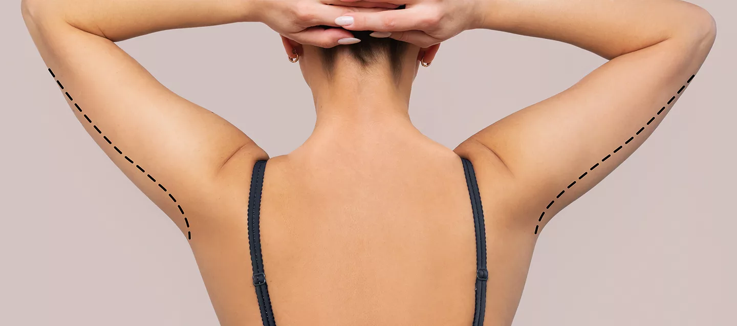 Arm Lift Surgery (Brachioplasty)