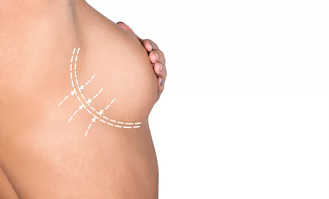 Breast Lift 02