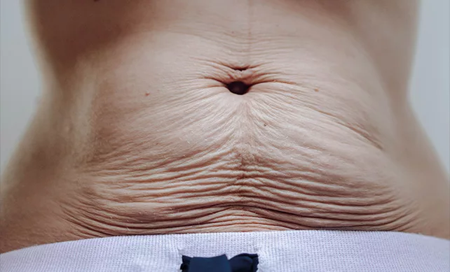 Gastric Bypass 01 germany