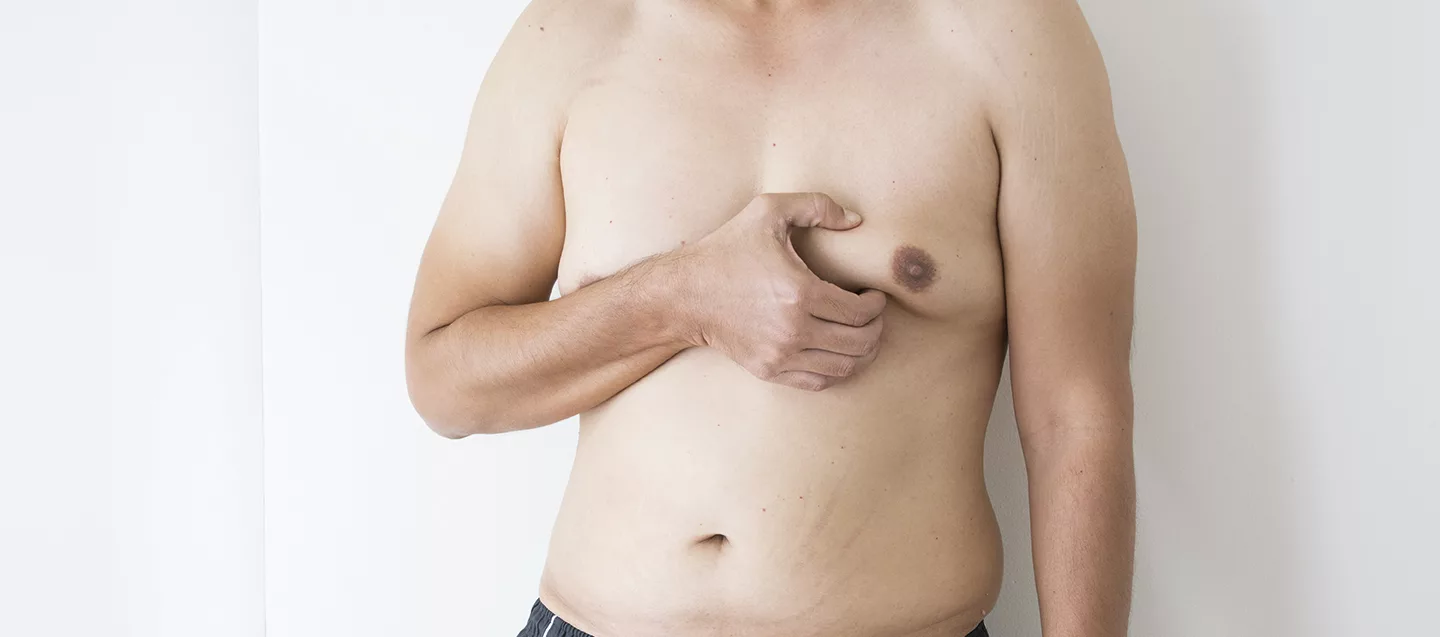 Gynecomastia