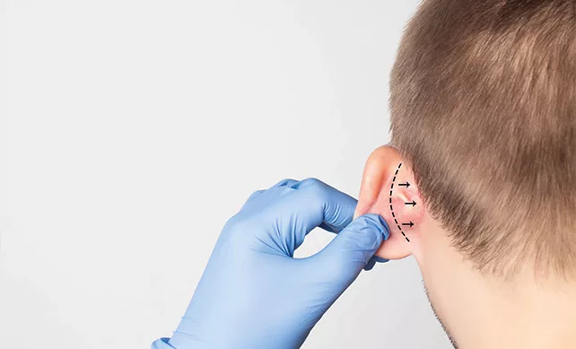 Otoplasty 02