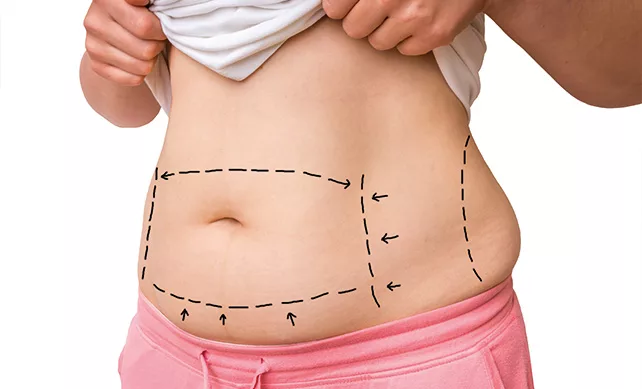 Tummy Tuck 02