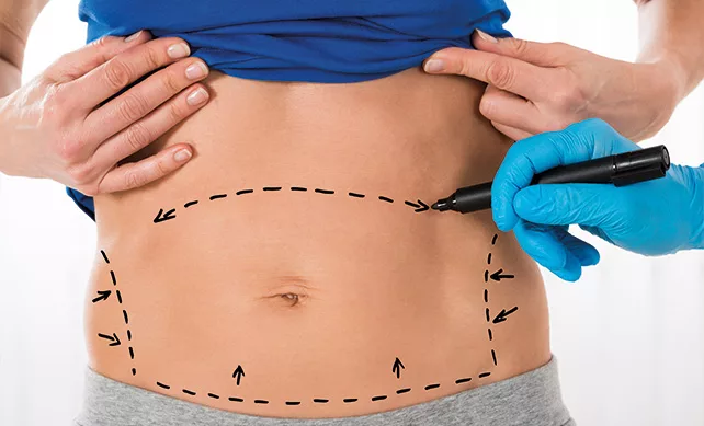 Tummy Tuck 03